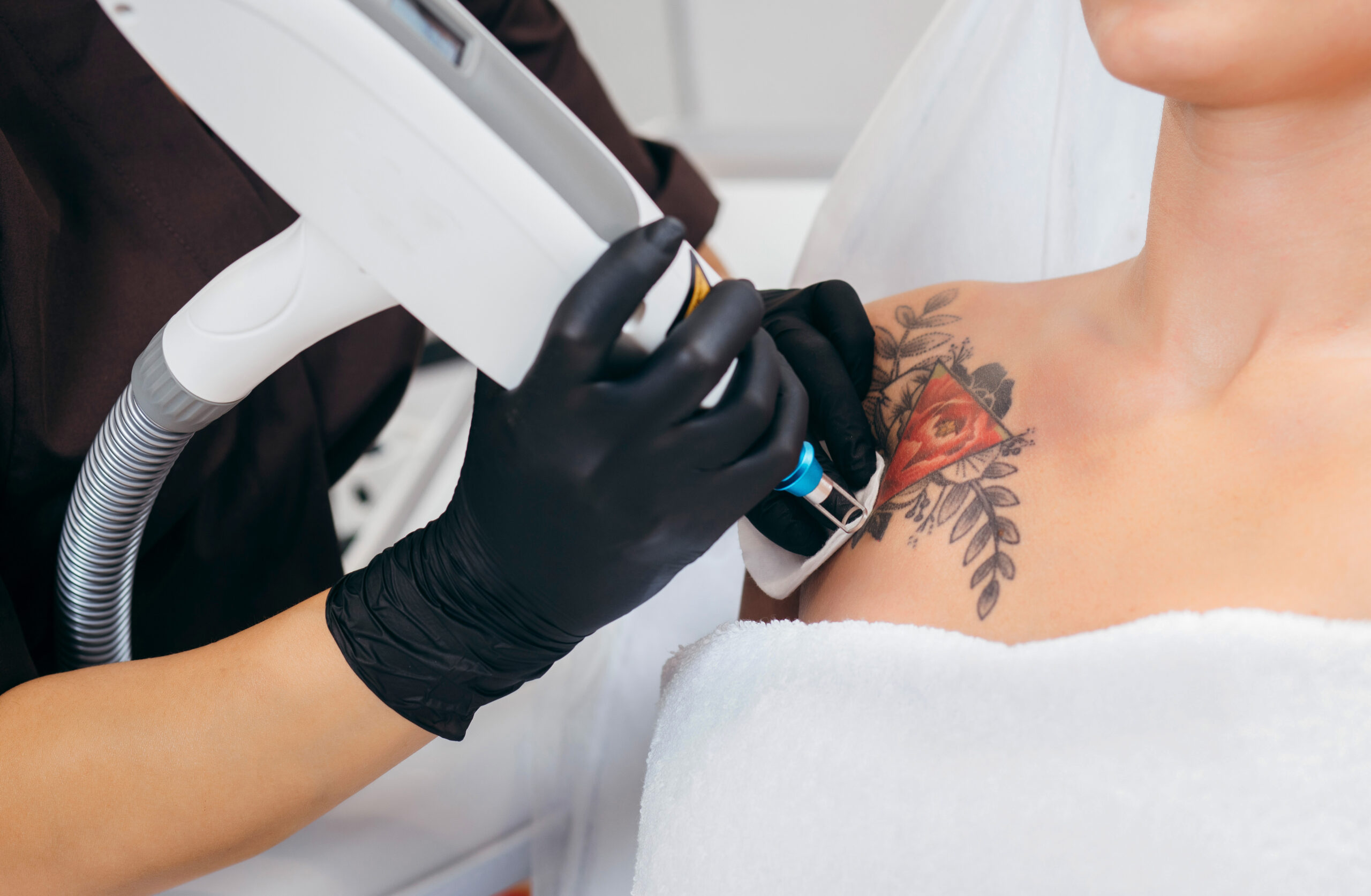 Removing regretful tattoos